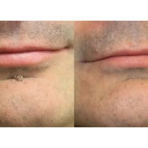 ✨Hiskin ® 2-in-1 Microneedle & Hydrocolloid Patch