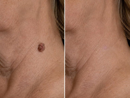✨Hiskin ® 2-in-1 Microneedle & Hydrocolloid Patch