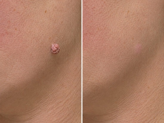 ✨Hiskin ® 2-in-1 Microneedle & Hydrocolloid Patch